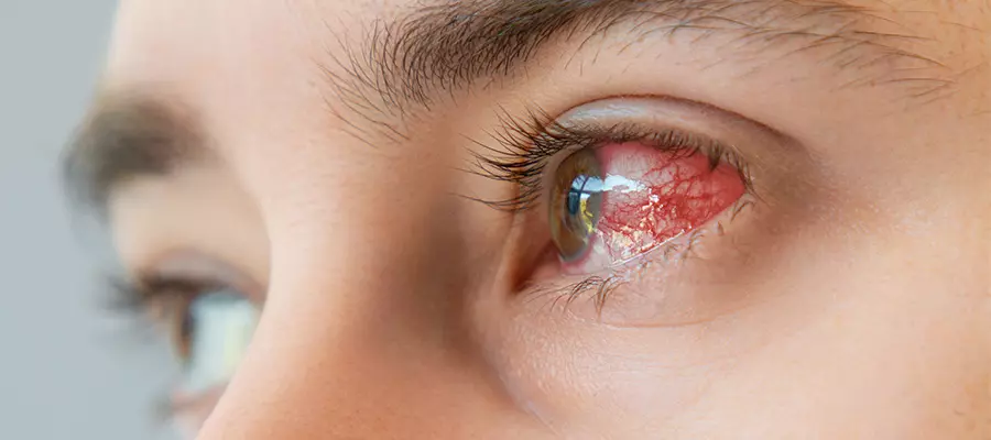 болят глаза болят глаза