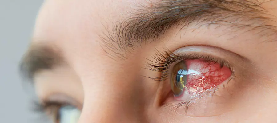 Кератит: симптомы и лечение