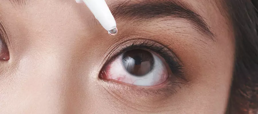 Эпикантус: что это такое и почему возникает третье веко