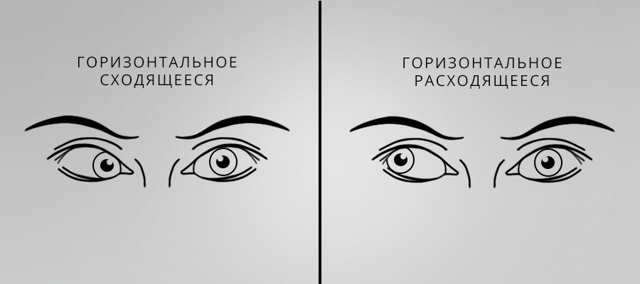 Косоглазие