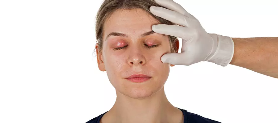 диагностика и лечение конъюнктивит