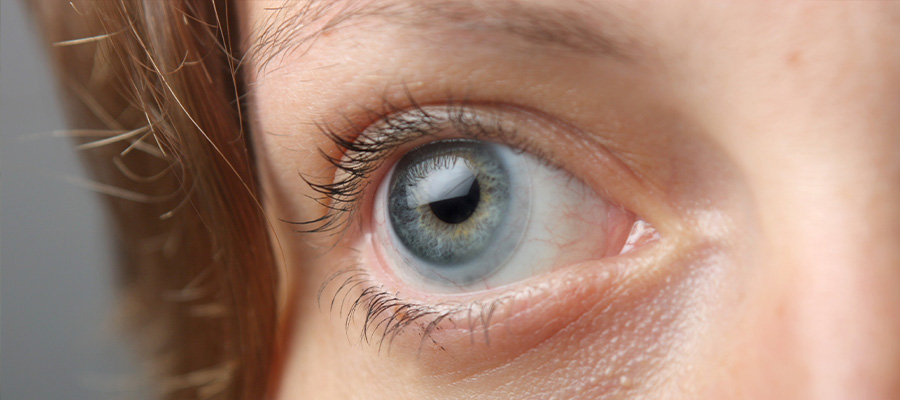 Аллергия на контактные линзы