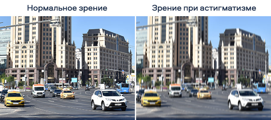 Контактные линзы при астигматизме у взрослых