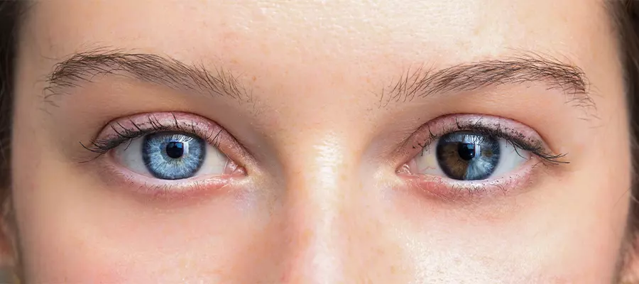 гетерохромия гетерохромия