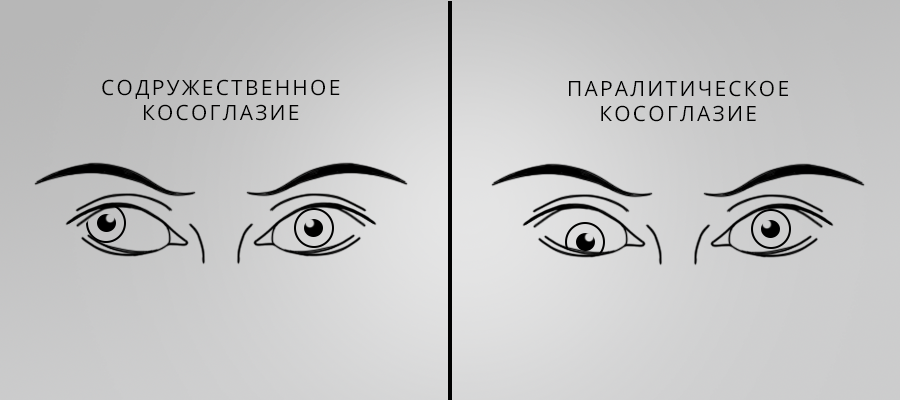 Косоглазие