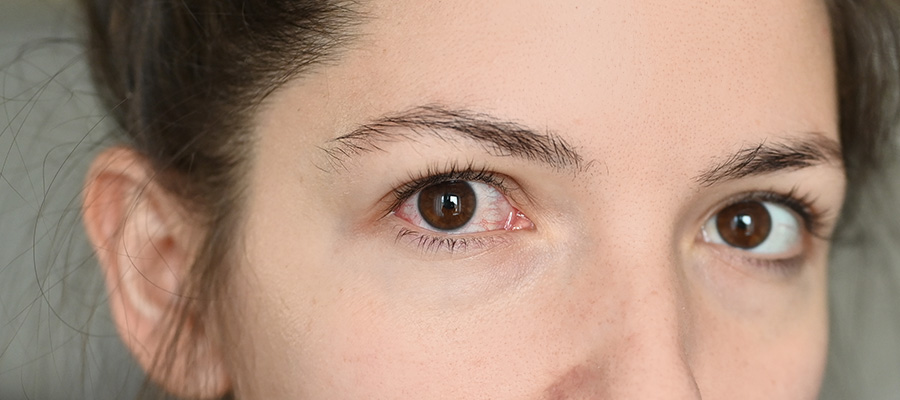 Аллергия на контактные линзы