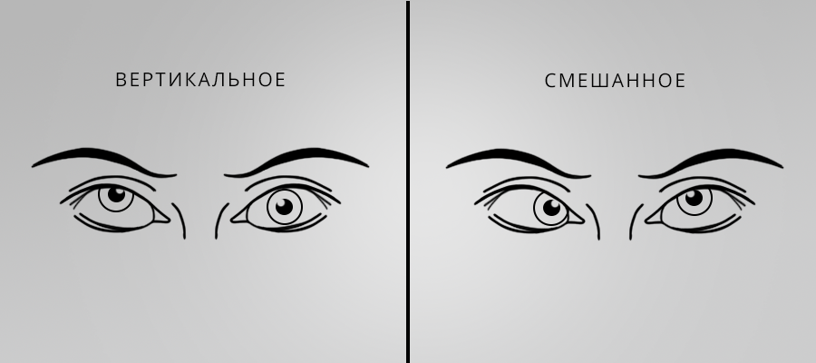 Косоглазие