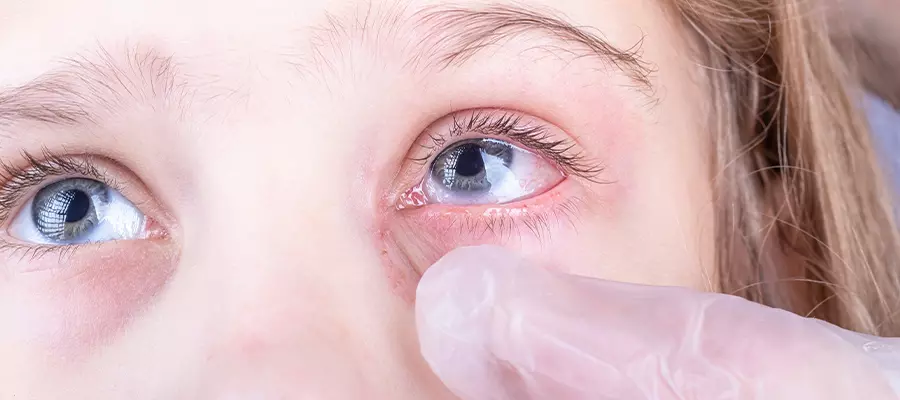 диагностика и лечение конъюнктивит