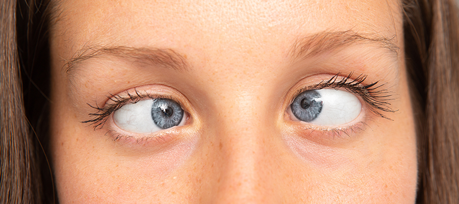 Косоглазие