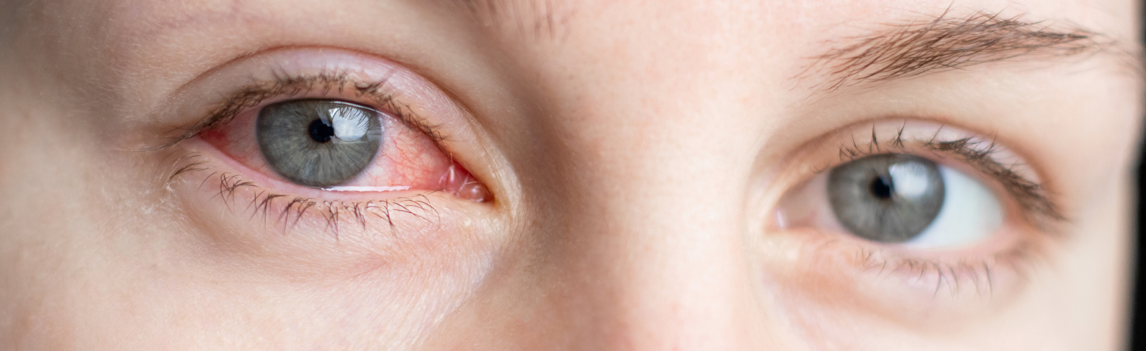 Гемофтальм