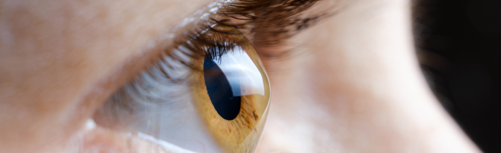 Кератоконус