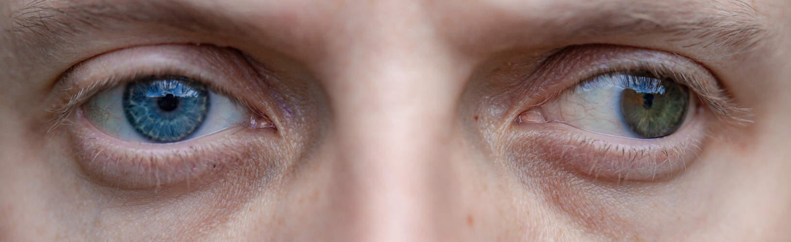 Косоглазие