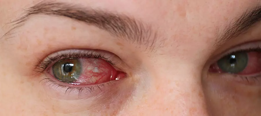 диагностика и лечение конъюнктивит