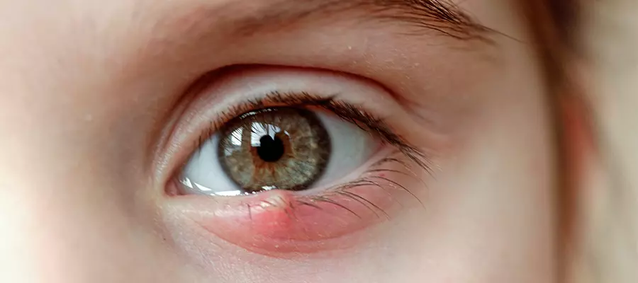 Причины появления ячменя Причины появления ячменя