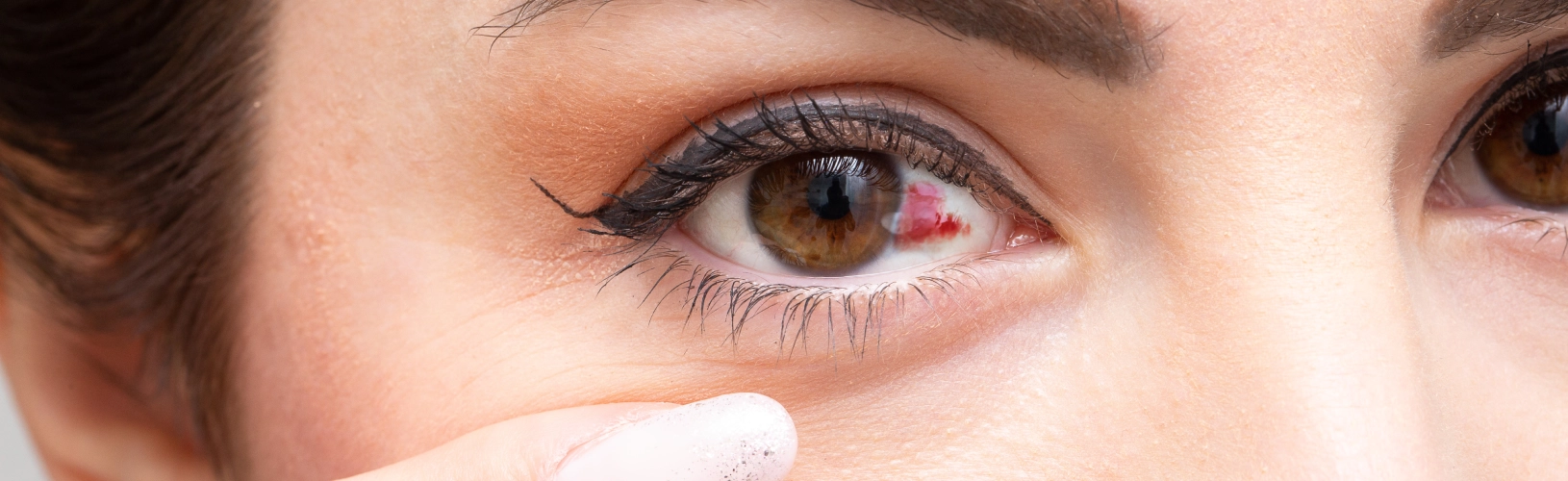 Кровоизлияние в глаз: виды, причины, лечение и когда срочно идти к врачу