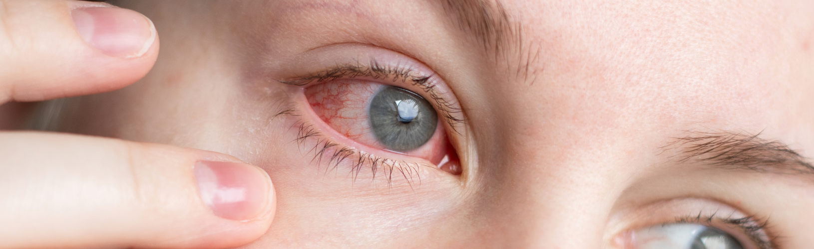 Ощущение инородного тела в глазу: причины, симптомы и лечение
