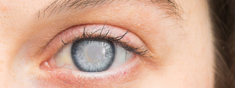 Поле зрения человека — что это такое, причины изменения, симптомы, диагностика, лечение