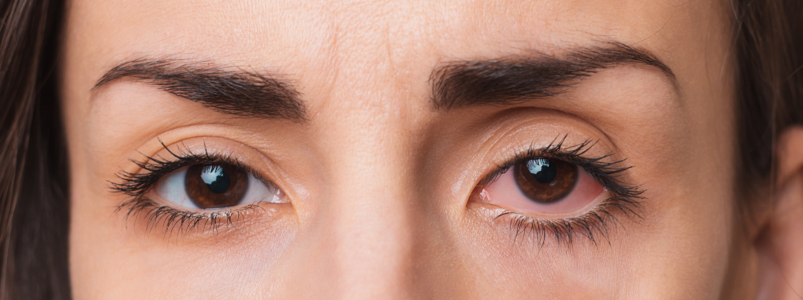 Слезятся глаза: причины, лечение и когда пора к врачу-офтальмологу