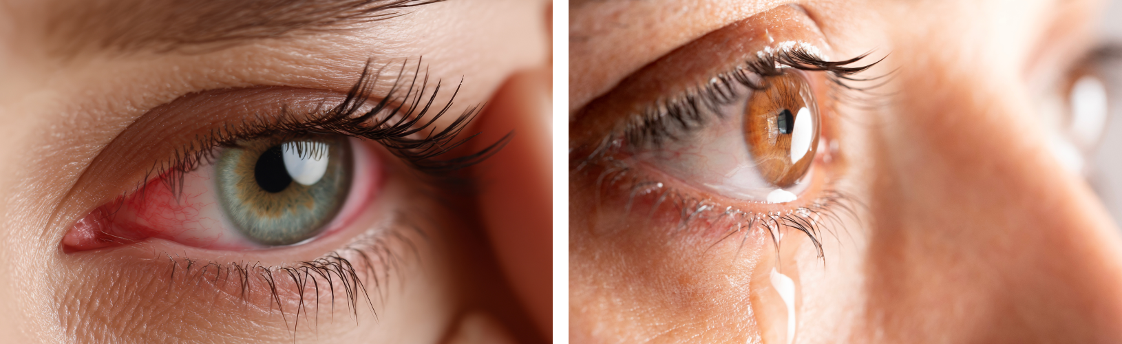 Синдром сухого глаза: причины, симптомы и лечение