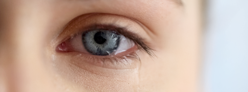 Синдром сухого глаза: причины, симптомы и лечени