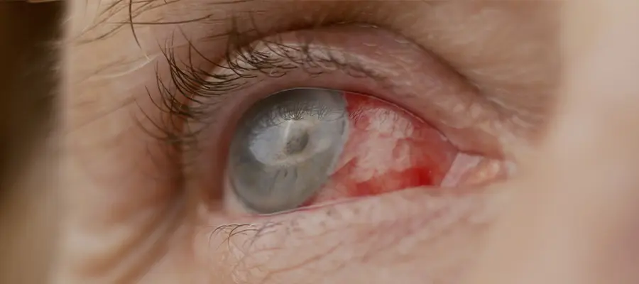 Степени ожогов