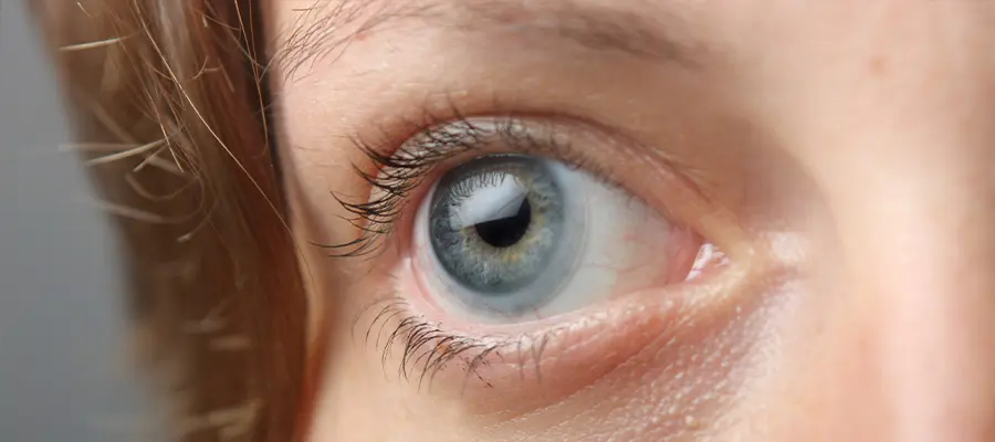 Аллергия на контактные линзы