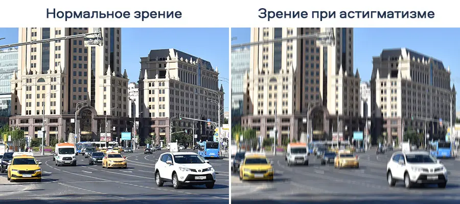 Контактные линзы при астигматизме у взрослых