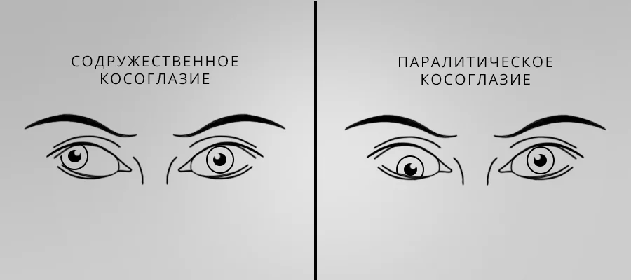 Косоглазие