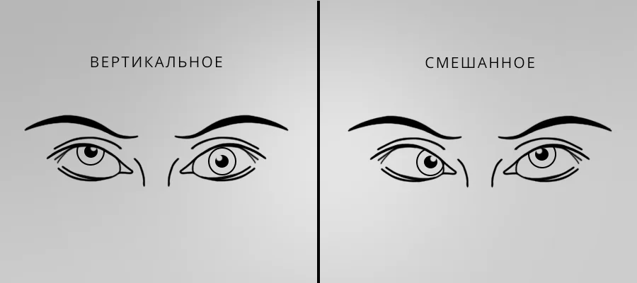 Косоглазие