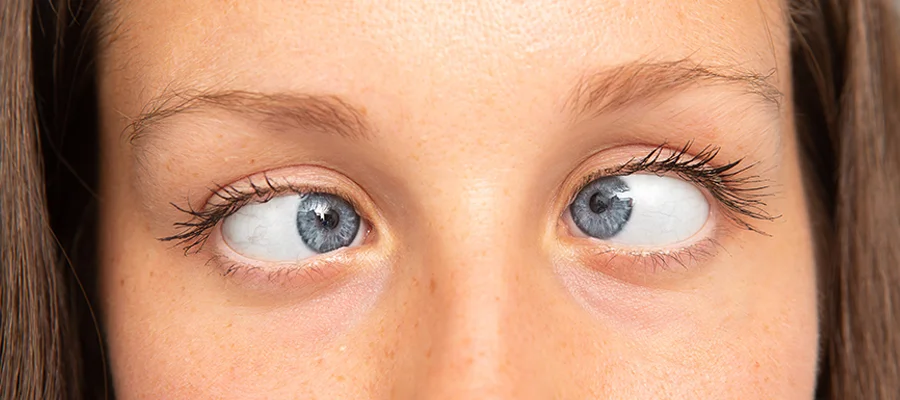 Косоглазие