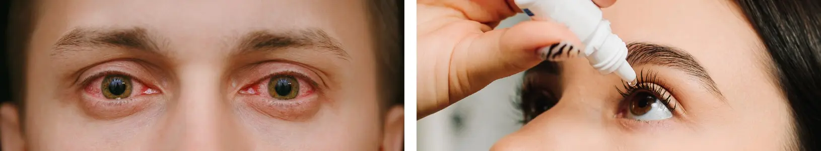 Боль в уголках глаз