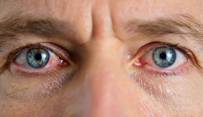 Как выбрать линзы для людей с синдромом сухого глаза