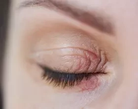 Почему возникает демодекоз