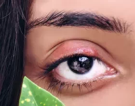 Что такое халязион или «шишка» на веке