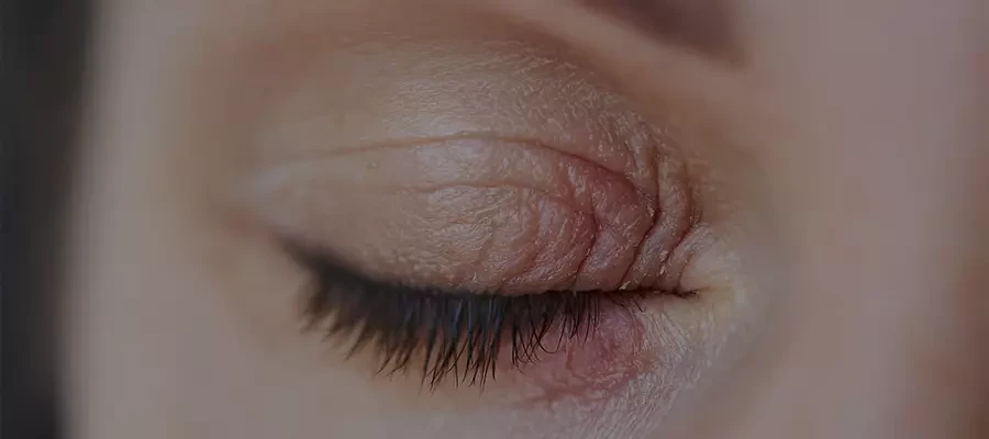 Почему возникает демодекоз