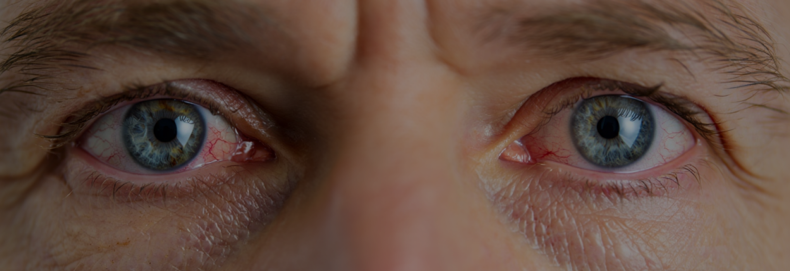 Как выбрать линзы для людей с синдромом сухого глаза