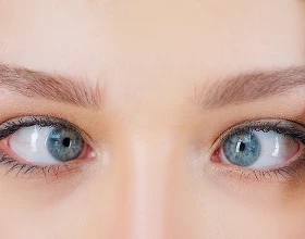 Линзы при косоглазии у взрослых