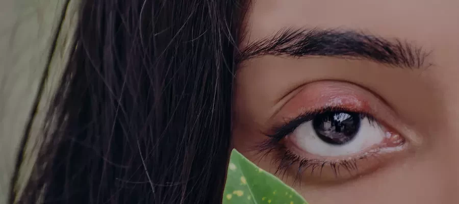 Что такое халязион или «шишка» на веке